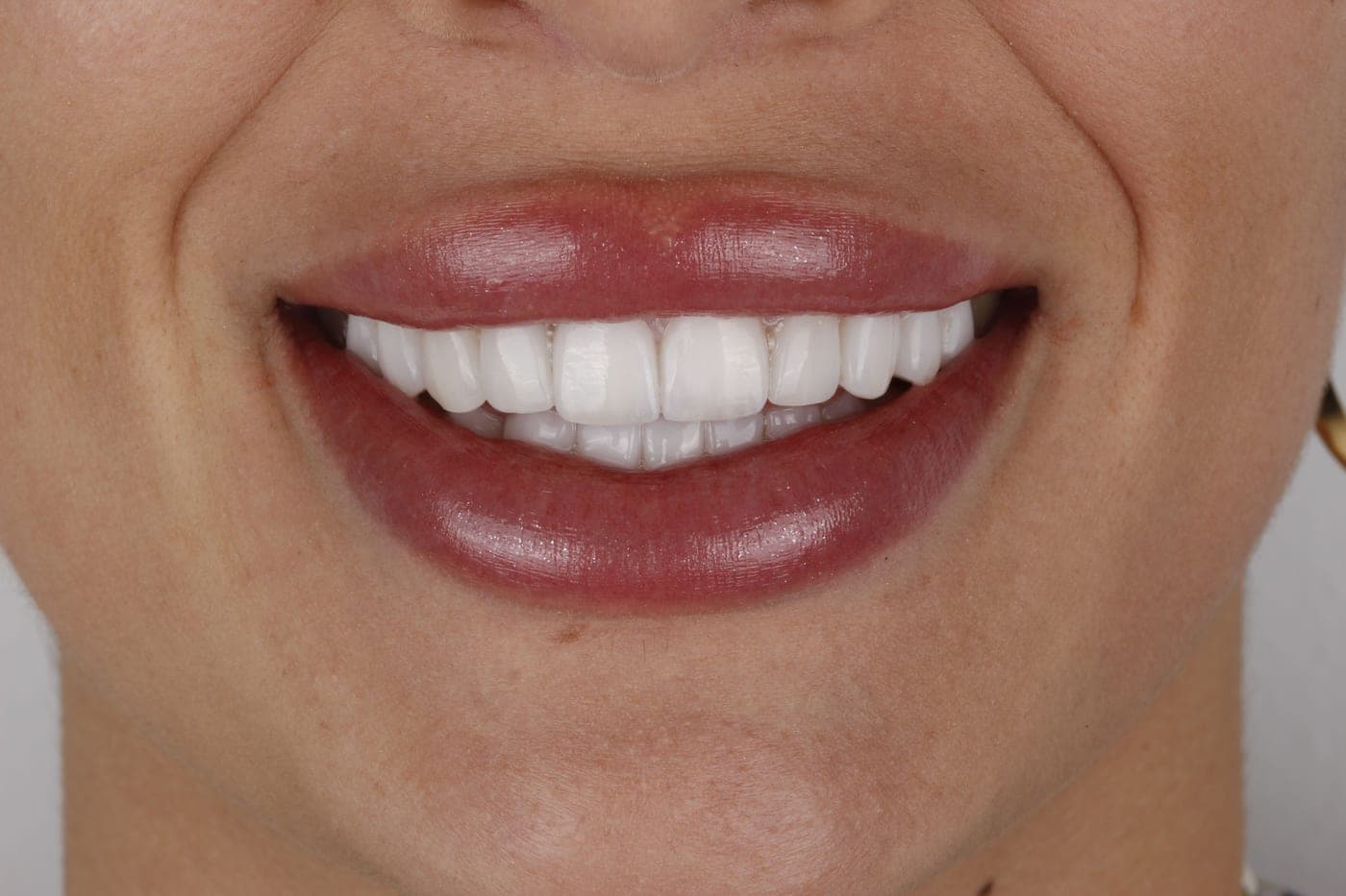 Three-quarter view of a smile with porcelain veneers