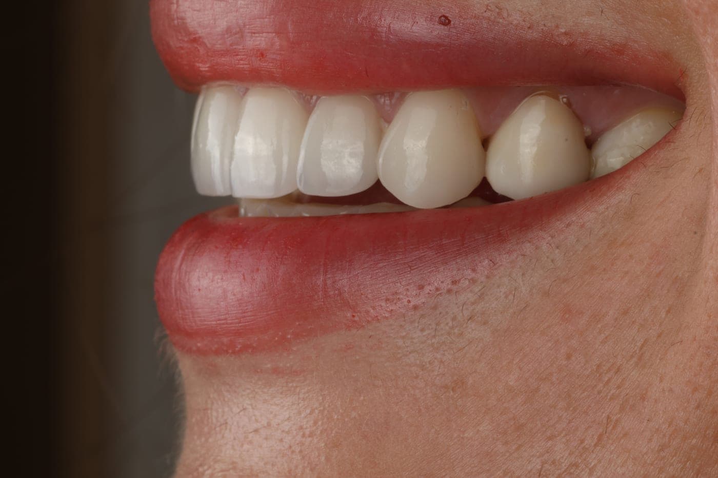 Profile view of the teeth showing the translucency of the edge