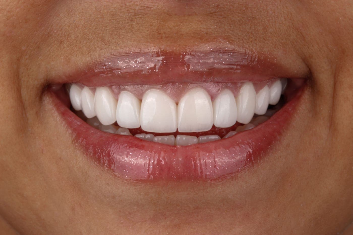 Close-up of a smile where the tooth shade harmonizes with the skin