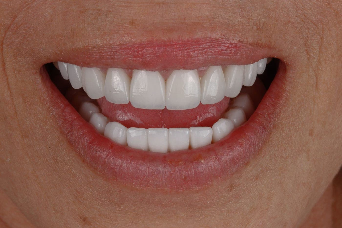 Wide front-facing smile showing the full line of the teeth