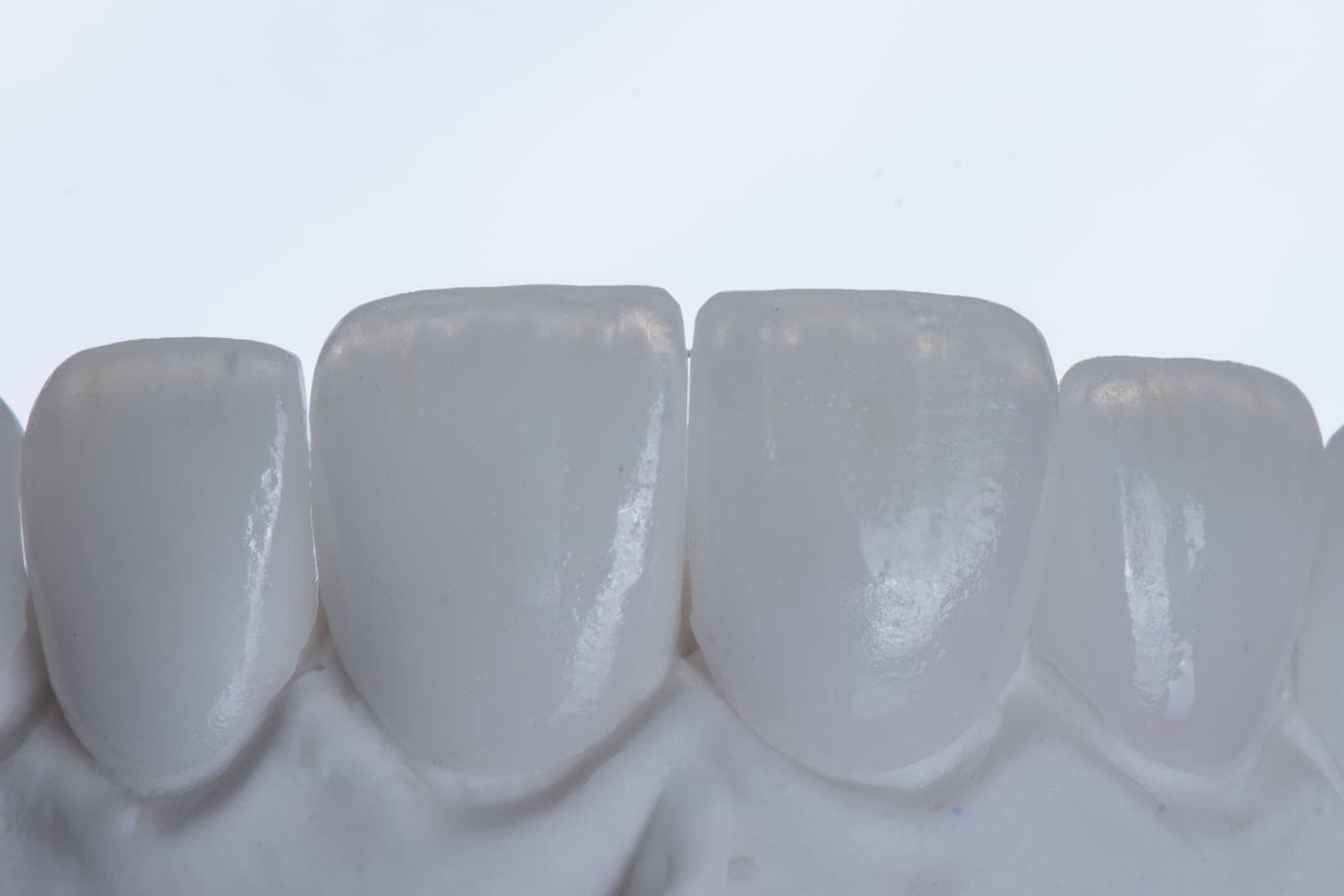 Macro of the porcelain veneers showing their thickness